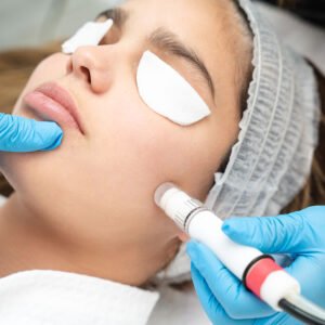 Mineral Microdermabrasion